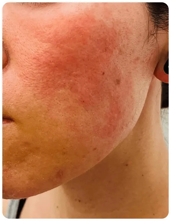 よもぎ蒸し3回の変化を示す写真一人目1回目の写真。赤みの強い頬の写真。