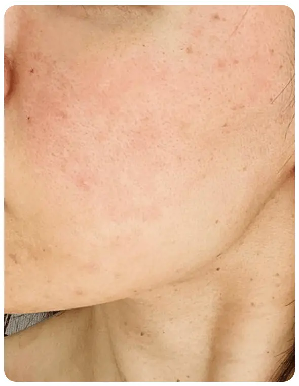 よもぎ蒸し3回の変化を示す写真一人目2回目の写真。頬の赤みが少しなくなった写真。