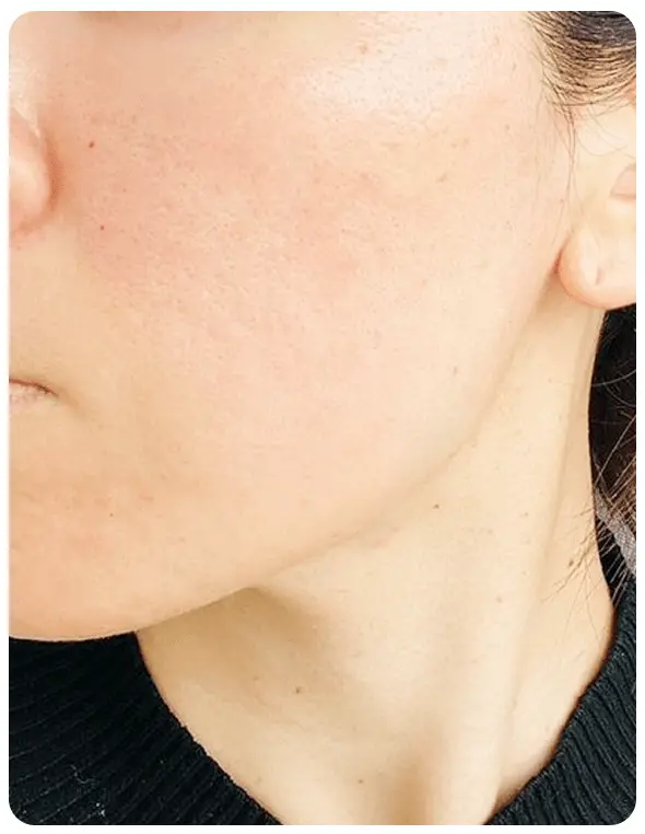 よもぎ蒸し3回の変化を示す写真一人目3回目の写真。頬の赤みがほぼなくなった写真。