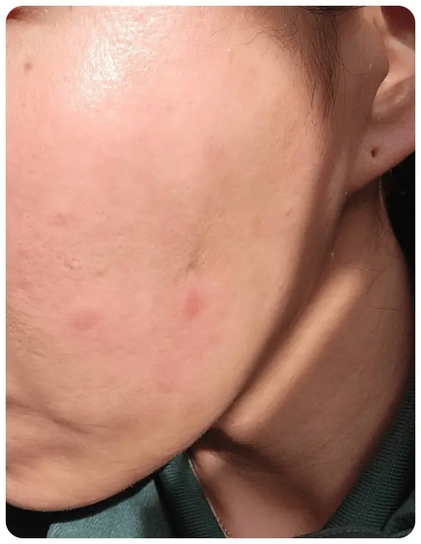 よもぎ蒸し3回の変化を示す写真2人目1回目の写真。ニキビがある写真。