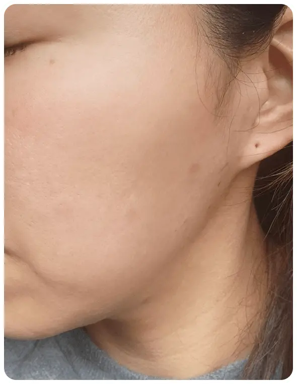 よもぎ蒸し3回の変化を示す写真2人目2回目の写真。ニキビが治りかけている写真。