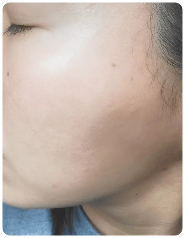 よもぎ蒸し3回の変化を示す写真2人目3回目の写真。ニキビがほとんどなくなった写真。