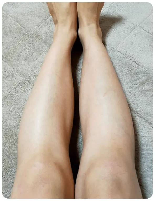 よもぎ蒸し3回の変化を示す写真3人目1回目の写真。浮腫んだ足の写真。